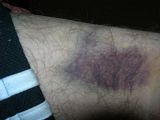 bruising